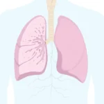 Lung Cancer