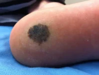 Acral Lentiginous Melanoma on the foot