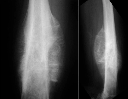 How osteosarcoma looks on x-ray
