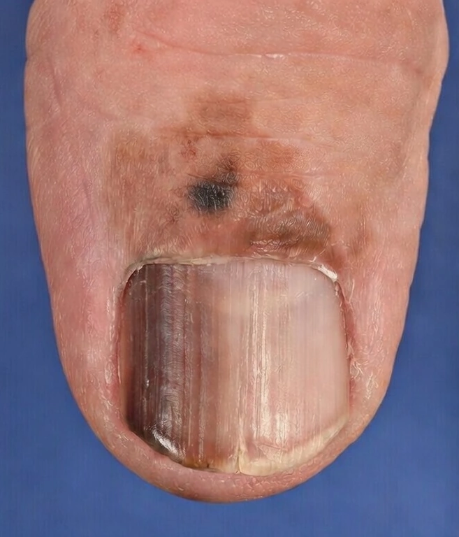 Hutchinson's sign of subungual melanoma on a finger