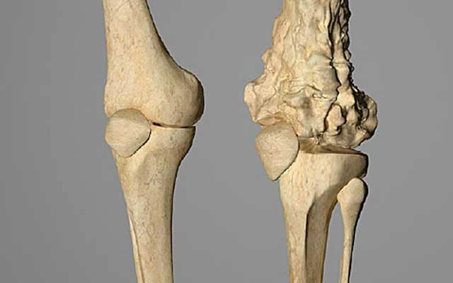 Osteosarcoma in the bone