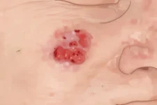 Squamous Cell Carcinoma symptoms and treatment guidelines